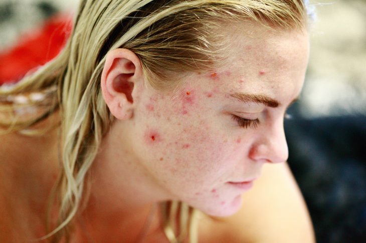 Come rimediare all’acne